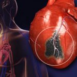 نکاتی درباره حمله قلبی