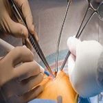 پیگیری و بررسی جراحی لیزری دیسک