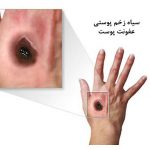 سیاه زخم